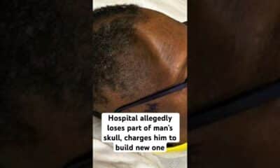 Hospital allegedly loses part of man’s skull