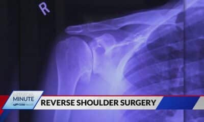 SSM Health Medical Minute: New technologies in shoulder surgery offer 3D planning and faster recover