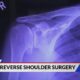 SSM Health Medical Minute: New technologies in shoulder surgery offer 3D planning and faster recover