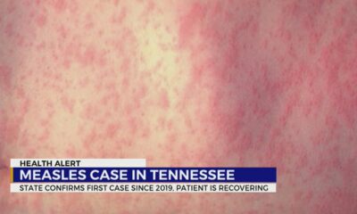 State confirms 1st measles case in TN since 2019