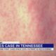 State confirms 1st measles case in TN since 2019