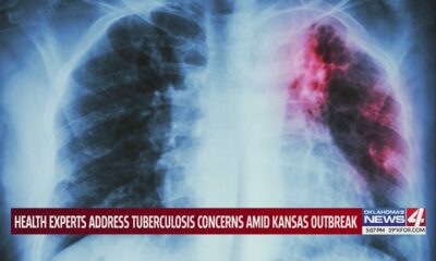 Health experts address Tuberculosis concerns amid Kansas outbreak