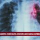 Health experts address Tuberculosis concerns amid Kansas outbreak