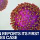 Measles: Infant in Austin tests positive for virus | FOX 7 Austin