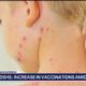 Texas measles outbreak 2025: More new cases detected in West Texas